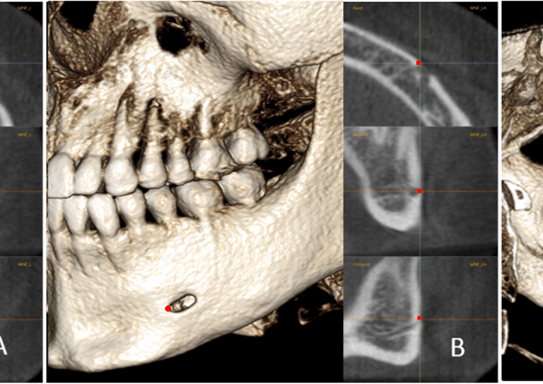 Stable mandibular landmarks in adolescent patients ...