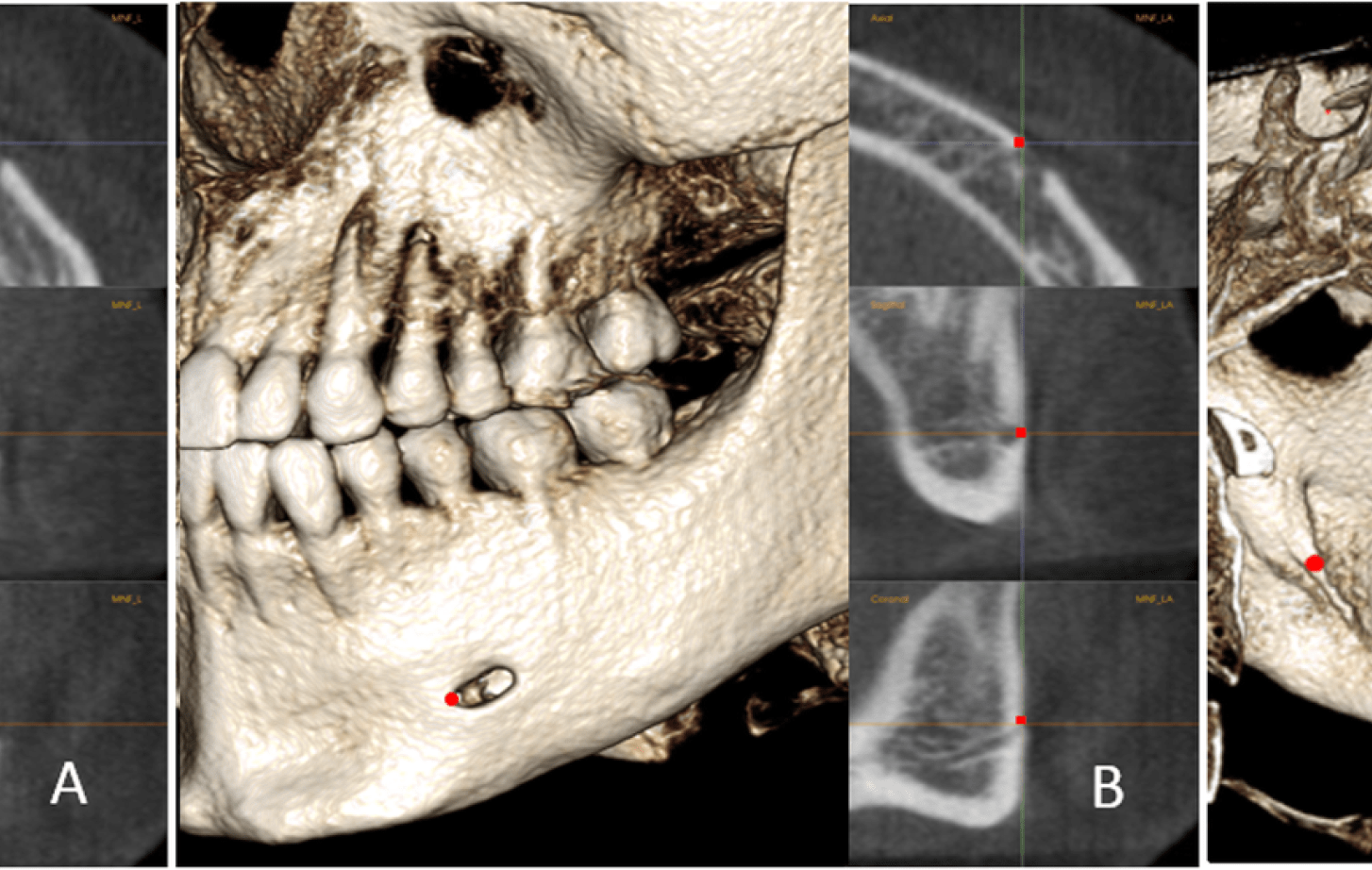 Stable mandibular landmarks in adolescent patients ...